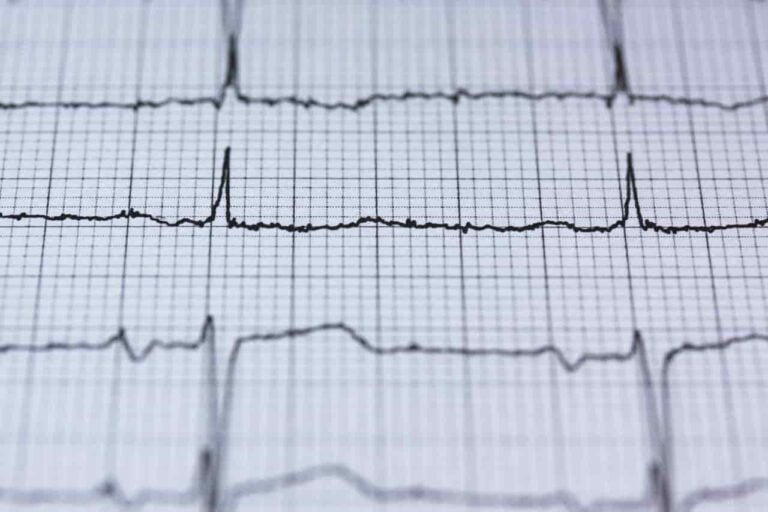 puls na ekg