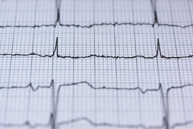 wysoki puls ekg